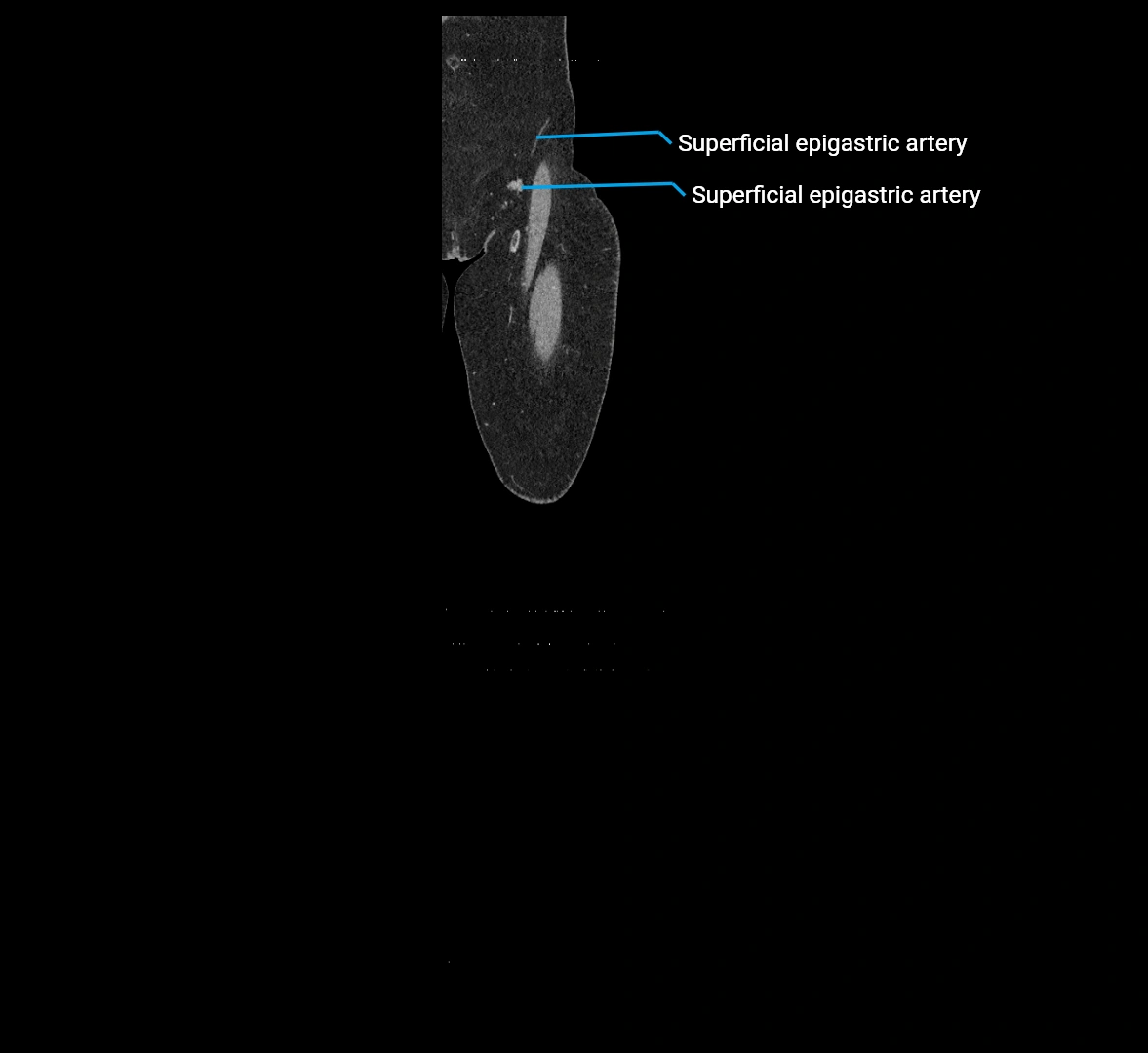CTA lower limb coronal cross sectional anatomy labelled image _2 (2).webp
